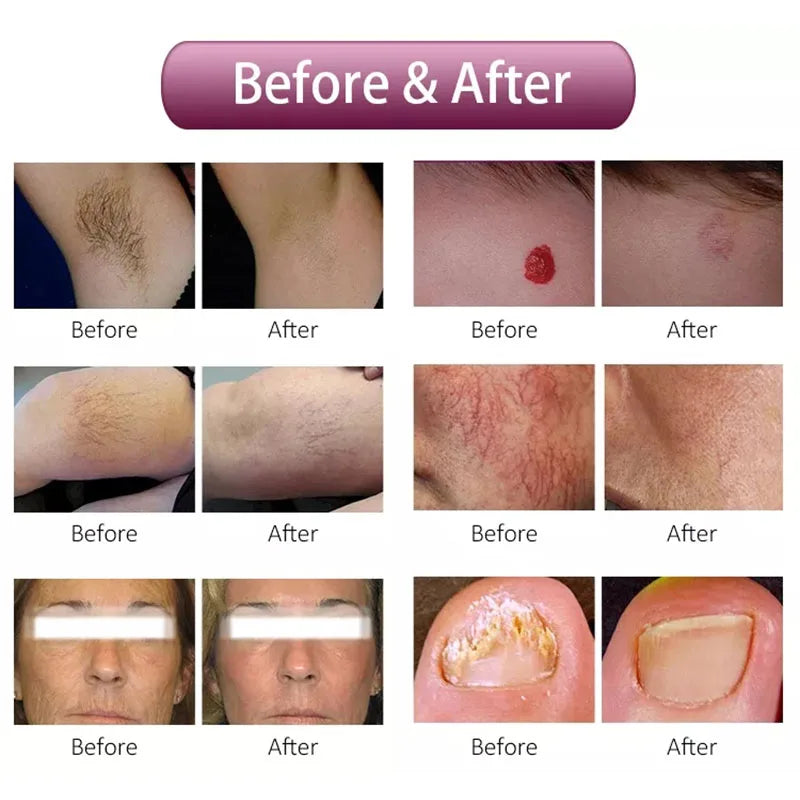 Professional Painless Hair Removal Clinic 808NM Alexandrite Machine